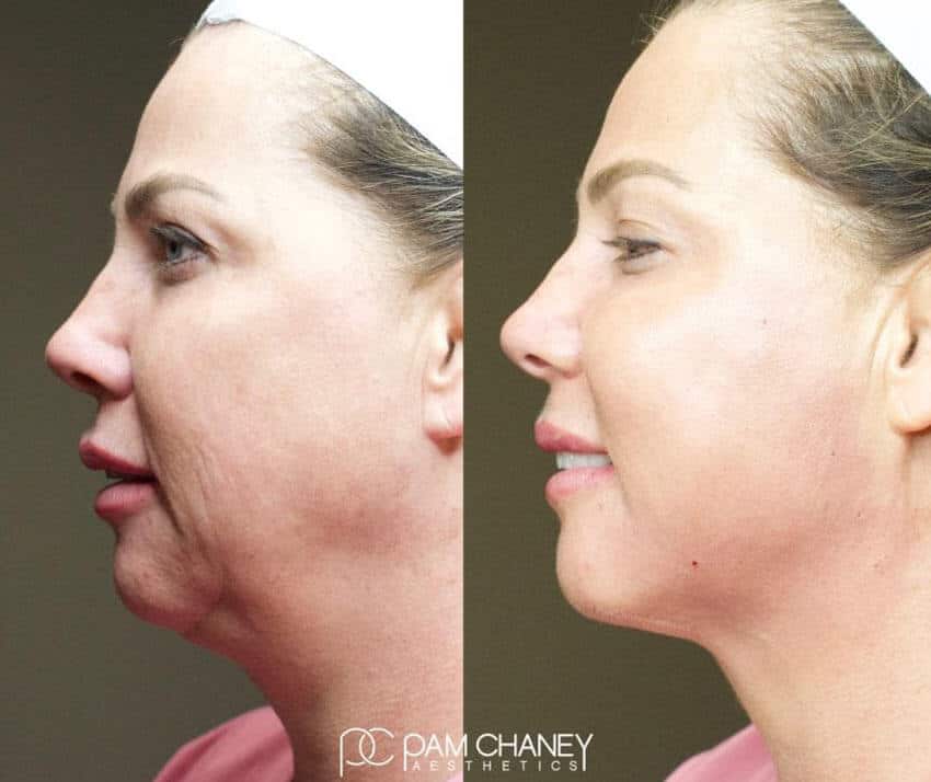 Before and After | Pam Chaney Aesthetics | Elkhart
