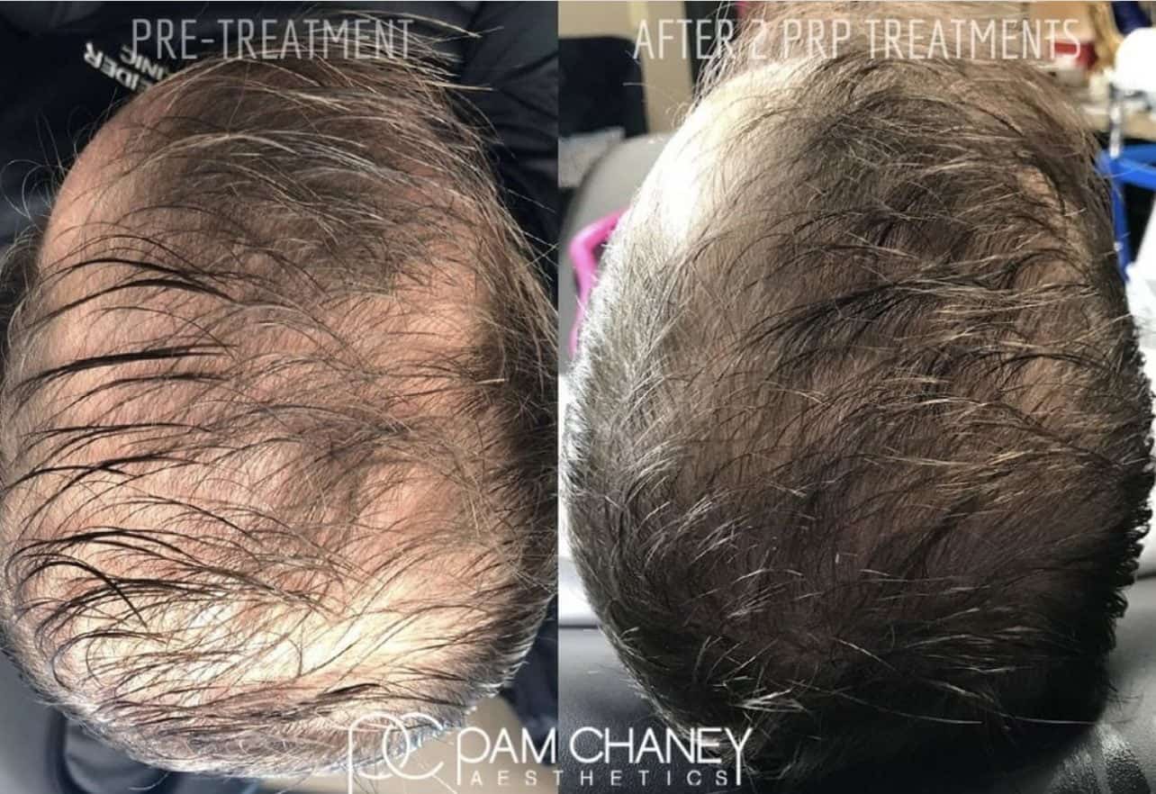 Hair Restoration Before and After | Pam Chaney Aesthetics in Elkhart, IN