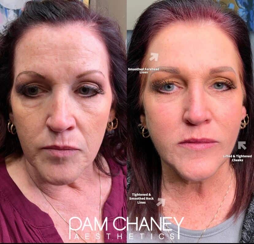 Before And After Morpheus full face and neck Treatment | Pam Chaney Aesthetics in Elkhart, IN