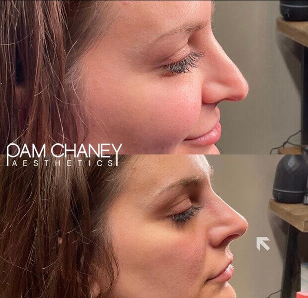 Before And After Nonsurgical rhinoplasty with Pdo threads| Pam Chaney Aesthetics in Elkhart, IN