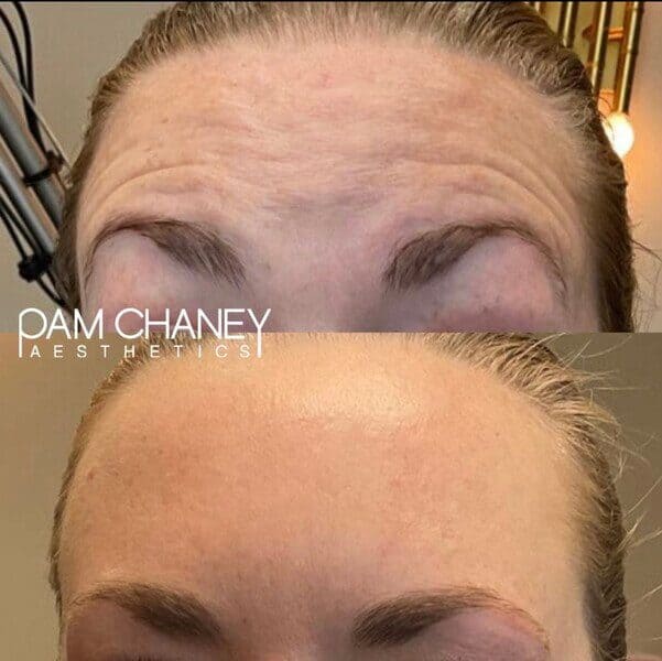 Before And After botox Treatment | Pam Chaney Aesthetics in Elkhart, IN