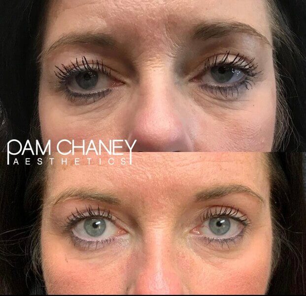 Before And After gallery co2 Eyes | Pam Chaney Aesthetics in Elkhart, IN