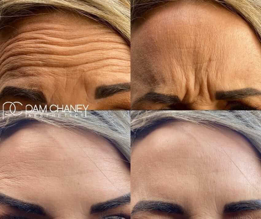 Before and After | Pam Chaney Aesthetics | Elkhart