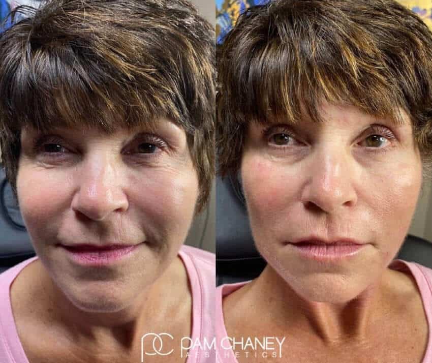 Before and After | Pam Chaney Aesthetics | Elkhart