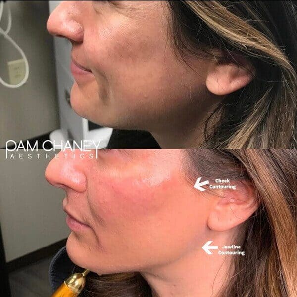 Before And After Cheek and Jawline Contouring | Pam Chaney Aesthetics in Elkhart, IN