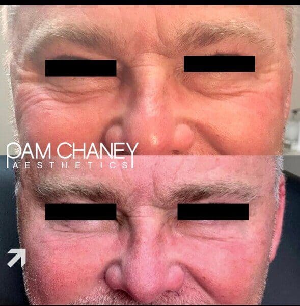 Before And After Morpheus 8 Treatment | Pam Chaney Aesthetics in Elkhart, IN