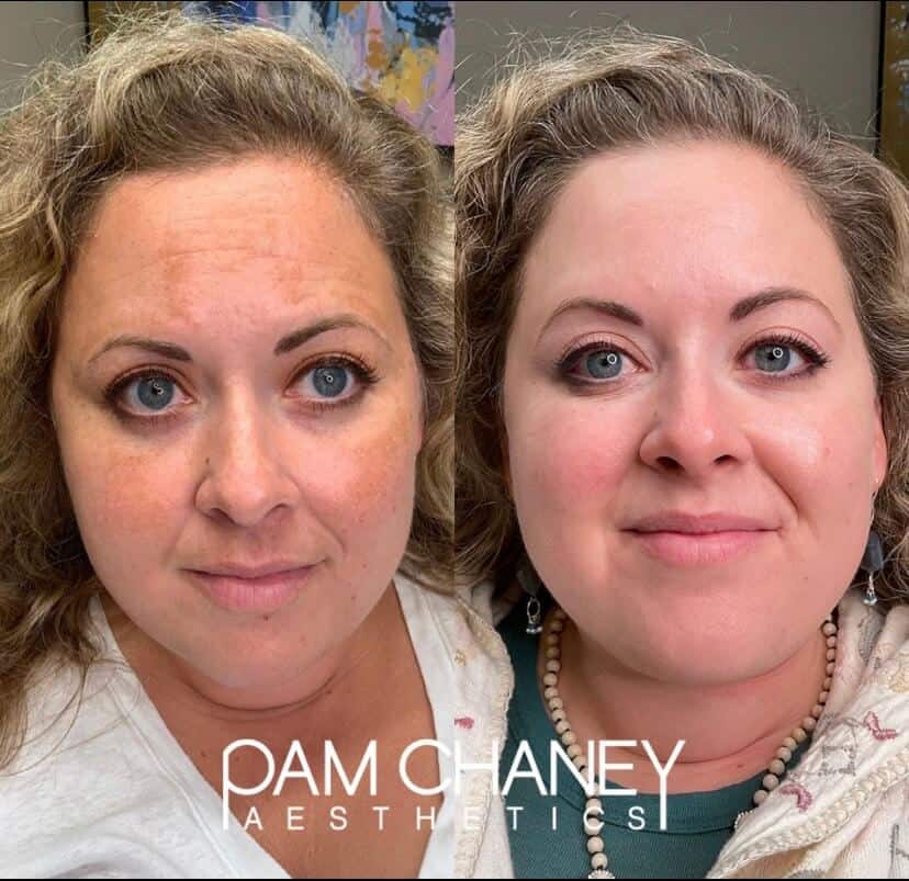 Before And After | Obagi Nuderm | Pam Chaney Aesthetics in Elkhart, IN