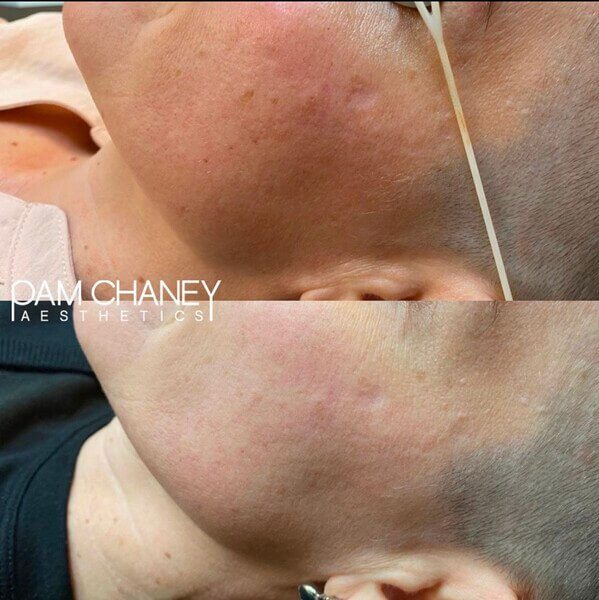 Before And After | Pico Laser | Pam Chaney Aesthetics in Elkhart, IN