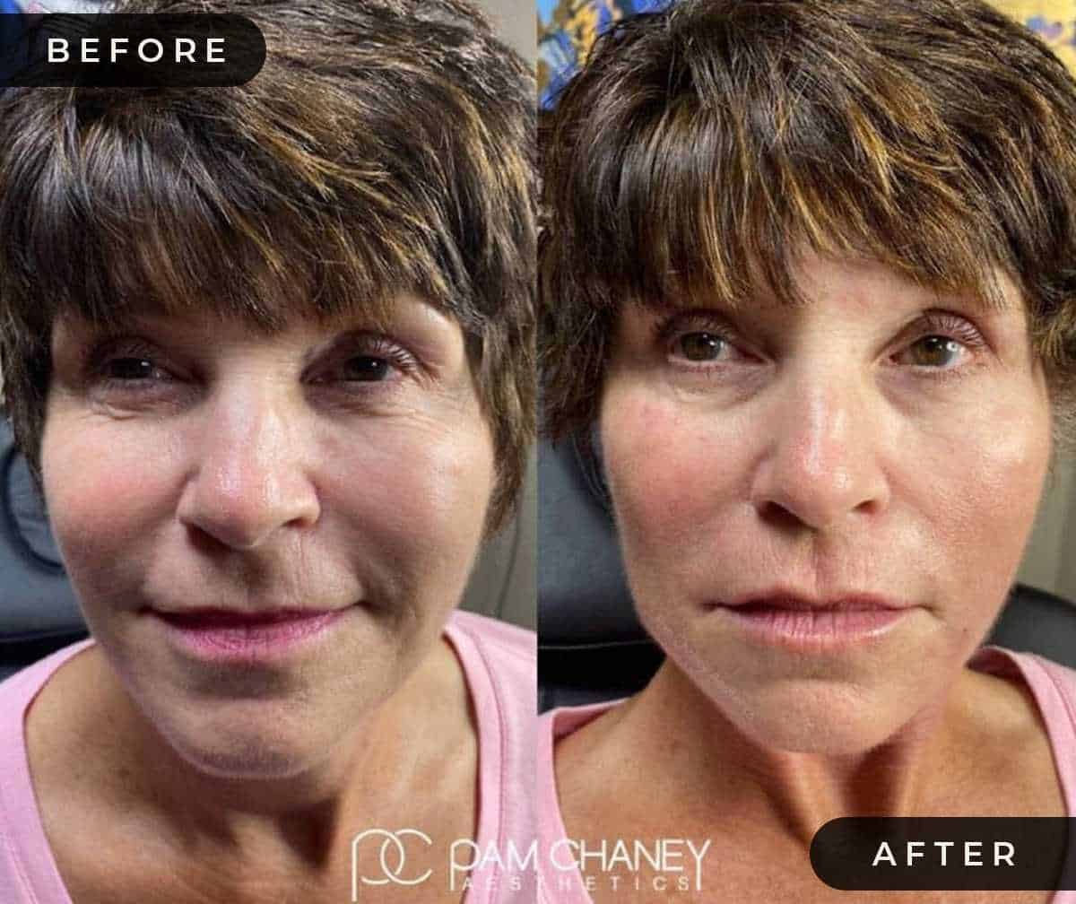 Botox Before & After | Pam Chaney Aesthetics | Elkhart IN