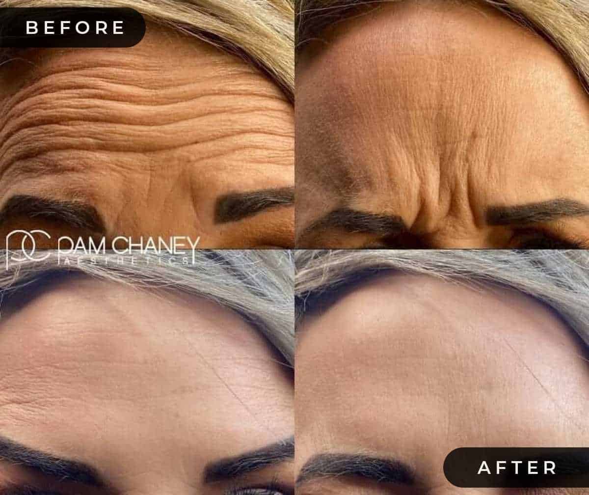 Botox Before & After | Pam Chaney Aesthetics | Elkhart IN