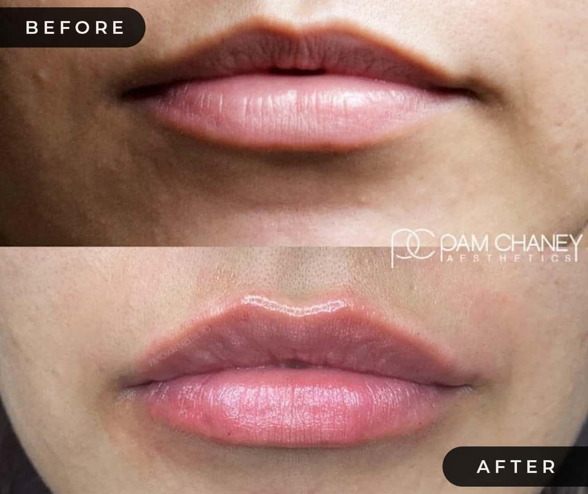 Lip Filler B&A | Pam Chaney Aesthetics | Elkhart IN