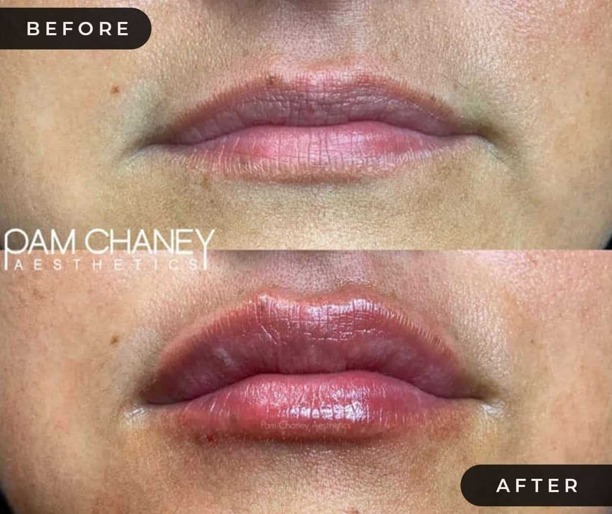 Lip Filler B&A | Pam Chaney Aesthetics | Elkhart IN