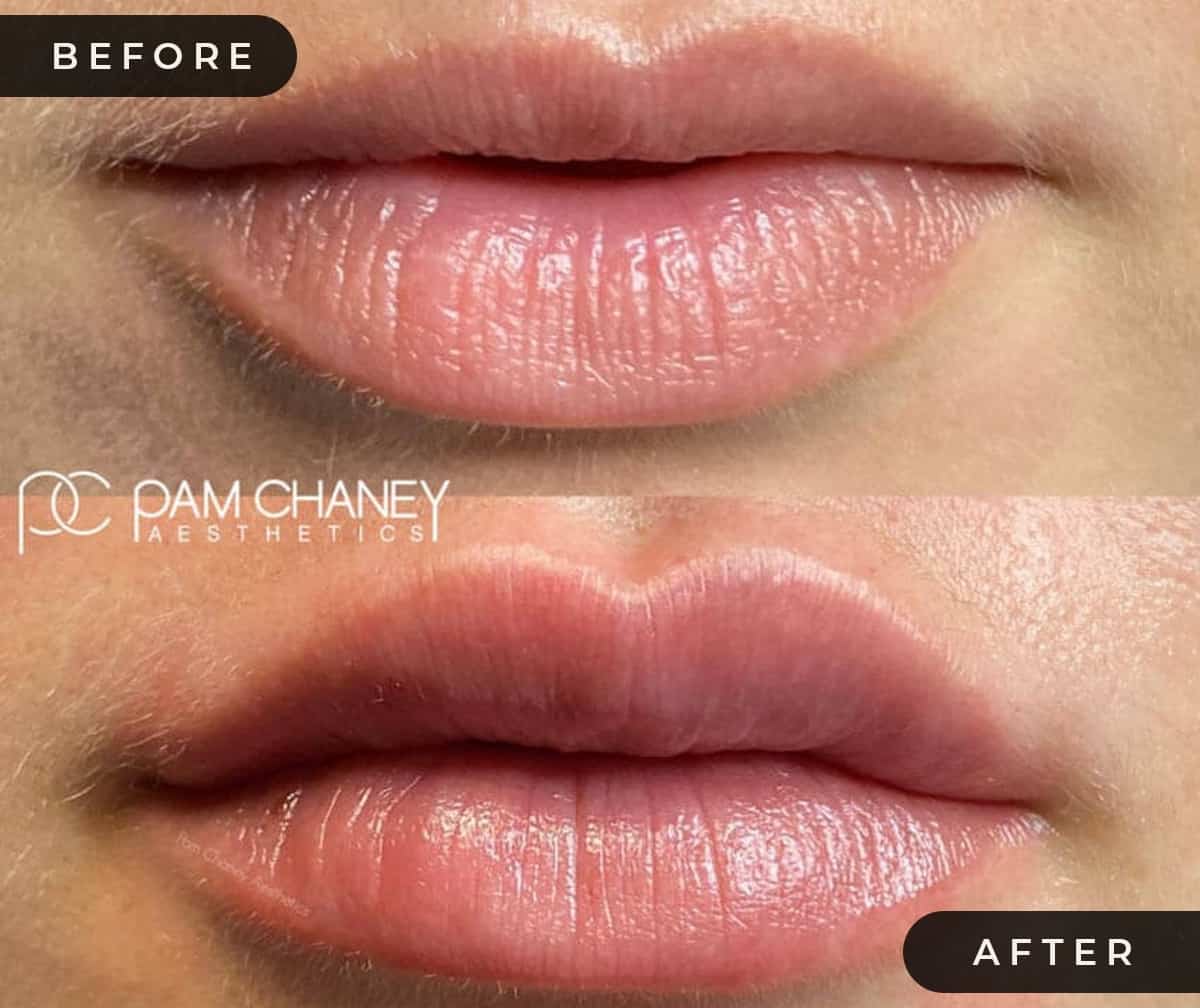 Lip Filler B&A | Pam Chaney Aesthetics | Elkhart IN