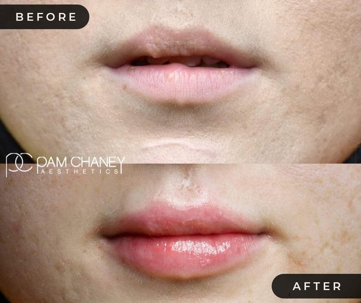 Lip Filler Before-after | Pam Chaney Aesthetics | Elkhart IN