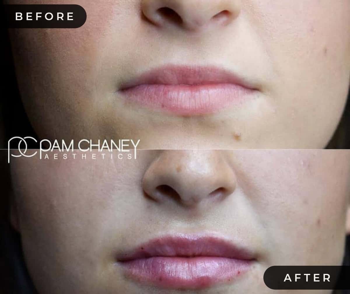 Lip Filler Before-after | Pam Chaney Aesthetics | Elkhart IN