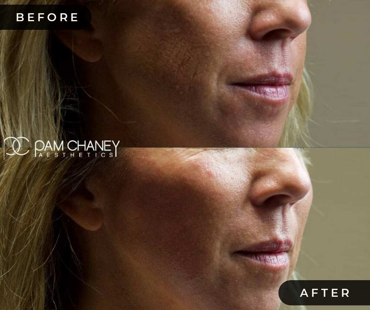 Lower face | Pam Chaney Aesthetics | Elkhart IN