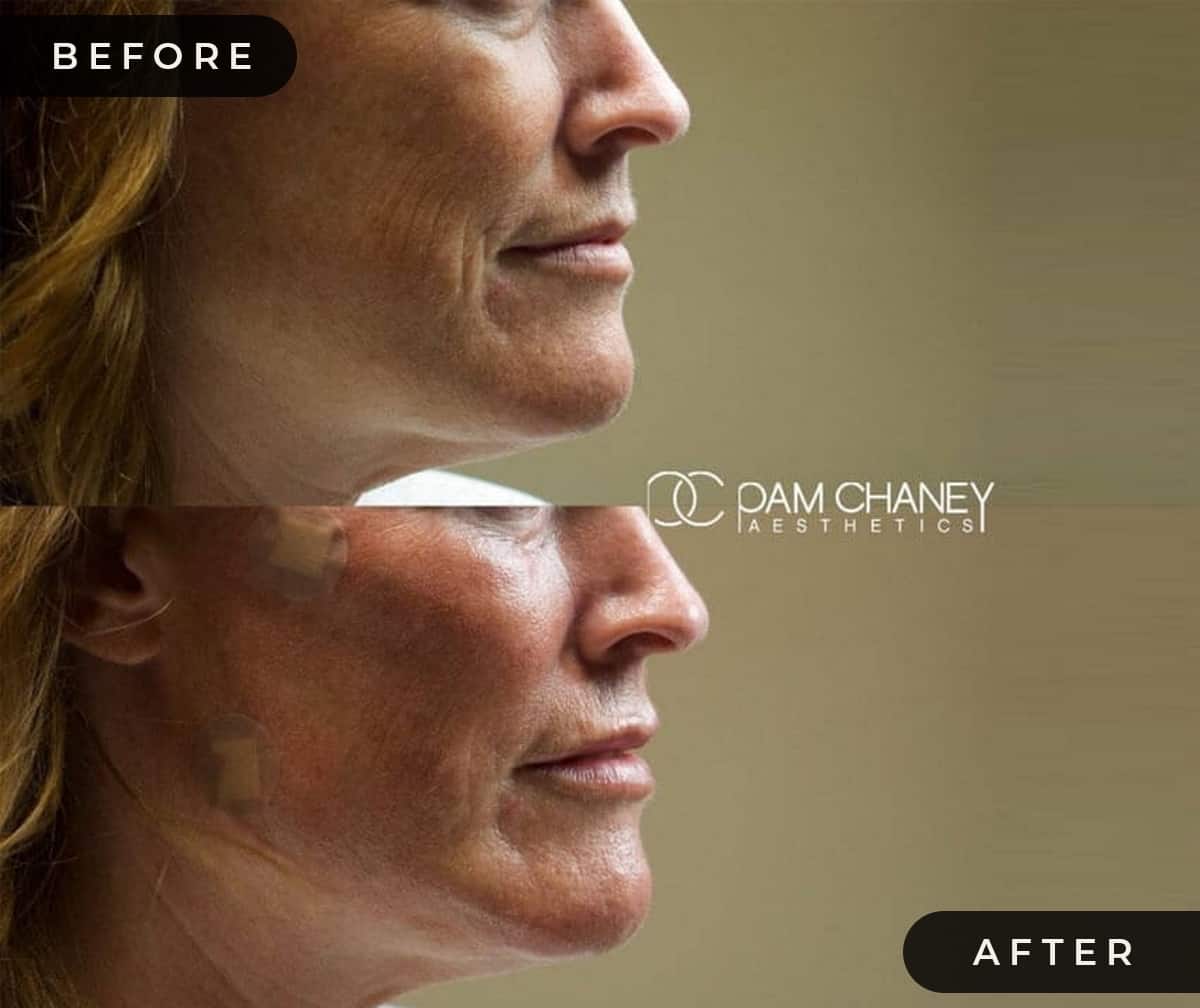 Nasolabial fold B&A 2 | Pam Chaney Aesthetics | Elkhart IN