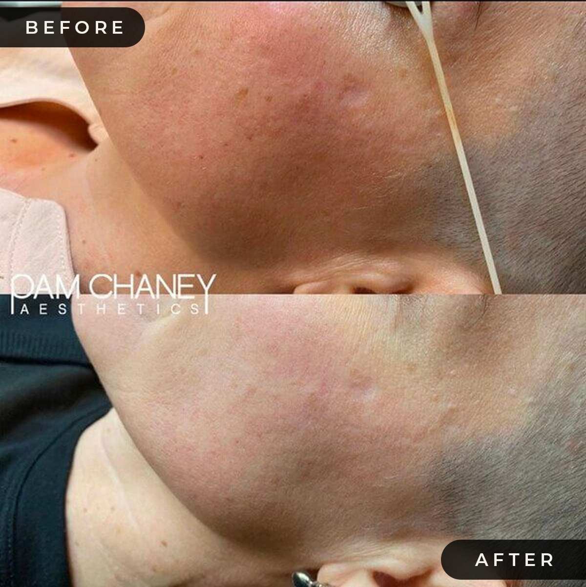 Pico-Laser-B&A | Pam Chaney Aesthetics | Elkhart IN