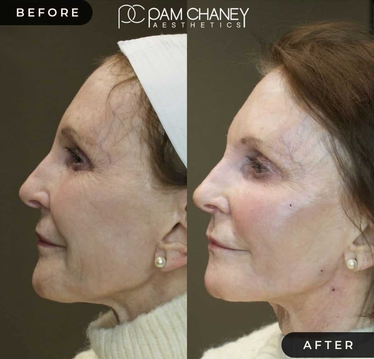 Threadlift Pamchaney | Pam Chaney Aesthetics | Elkhart IN