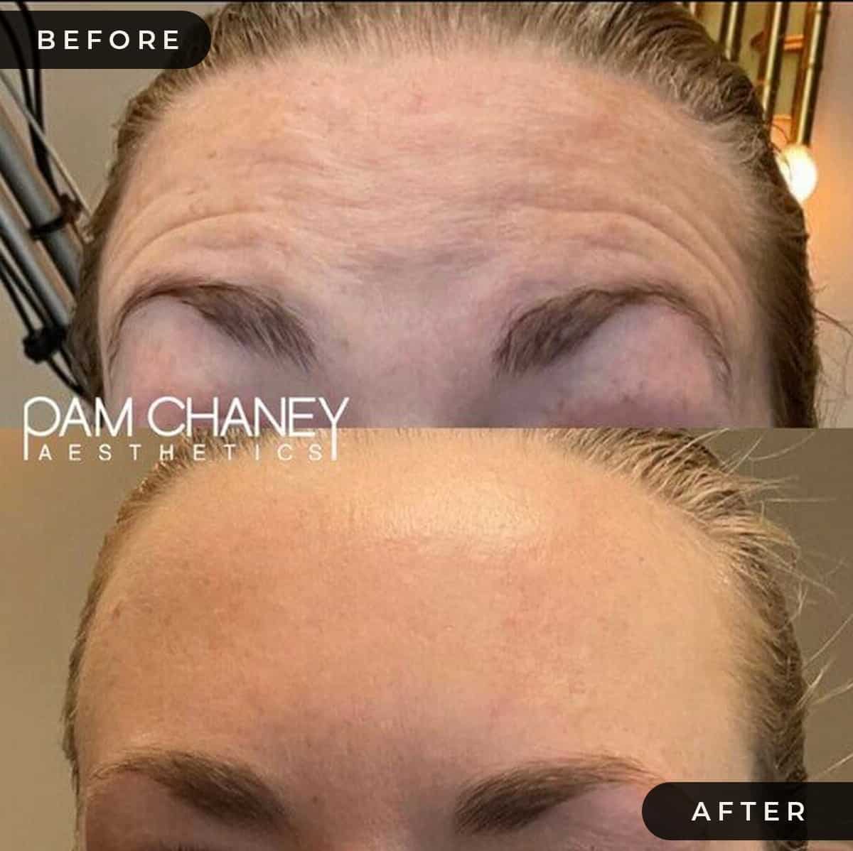 Botox | Pam Chaney Aesthetics | Elkhart IN