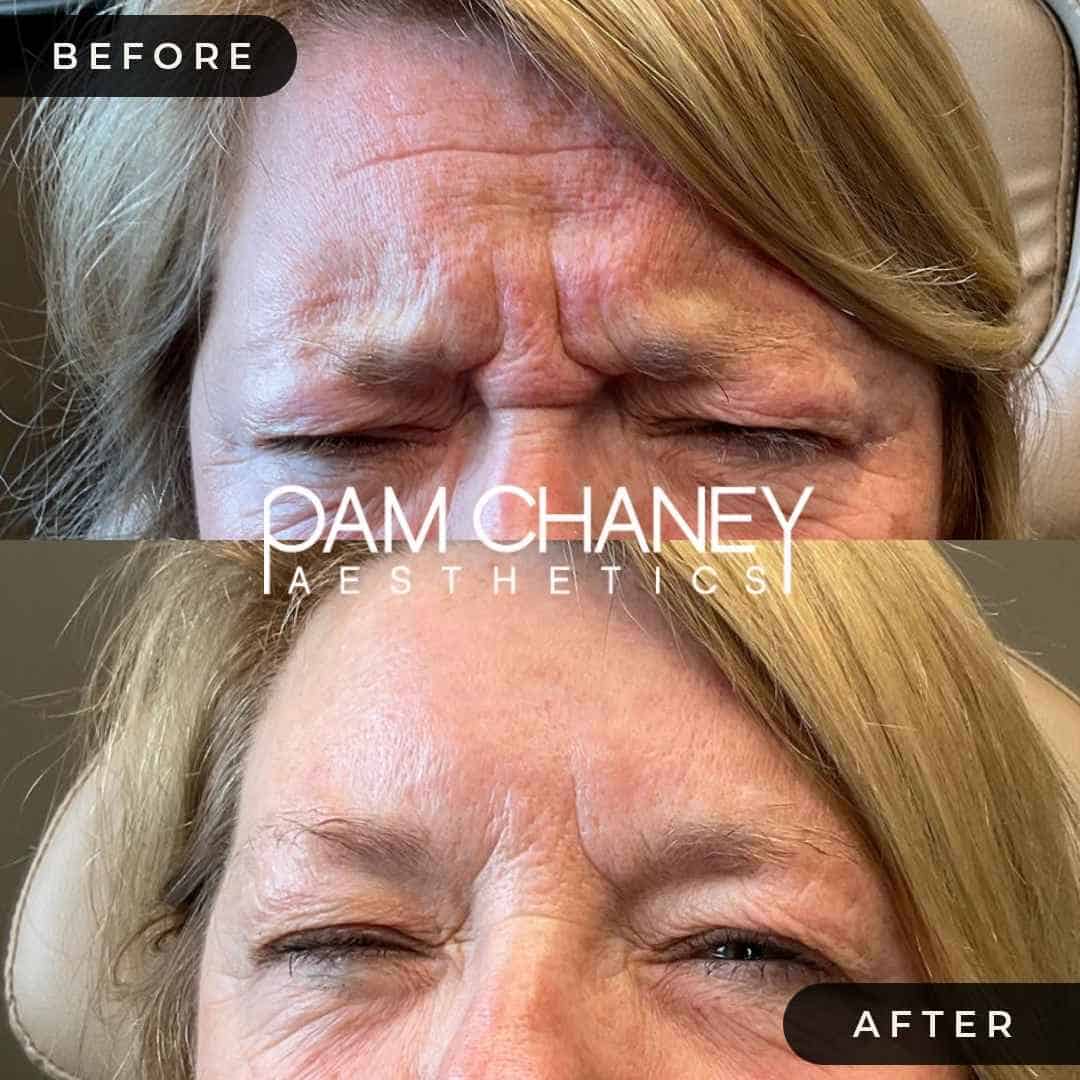 BOTULINUM TOXIN | Pam Chaney Aesthetics | Elkhart IN