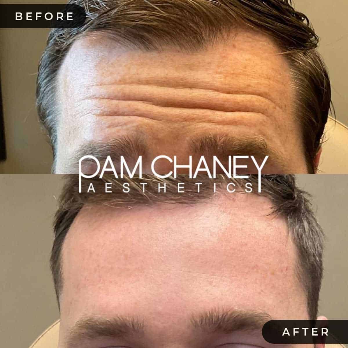 Botox Before & After | Pam Chaney Aesthetics | Elkhart IN