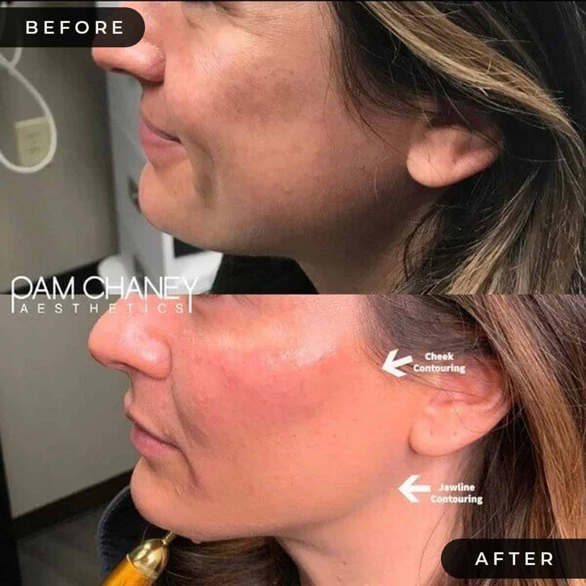 Contouring Pamchaney | Pam Chaney Aesthetics | Elkhart IN