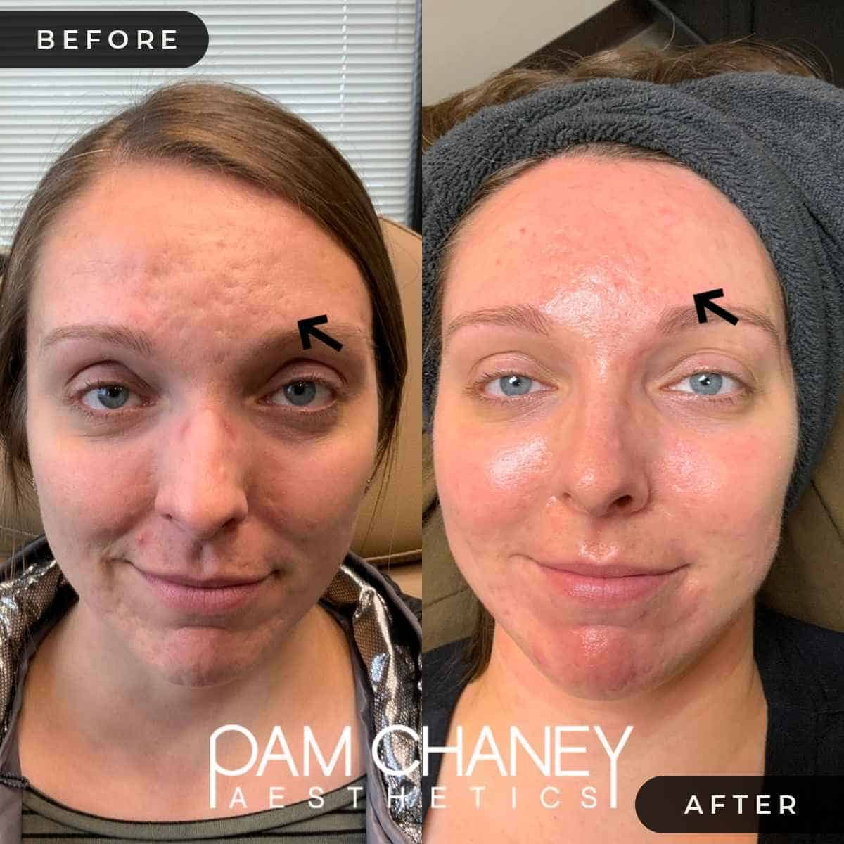 CoolPeel Before & After | Pam Chaney Aesthetics | Elkhart IN