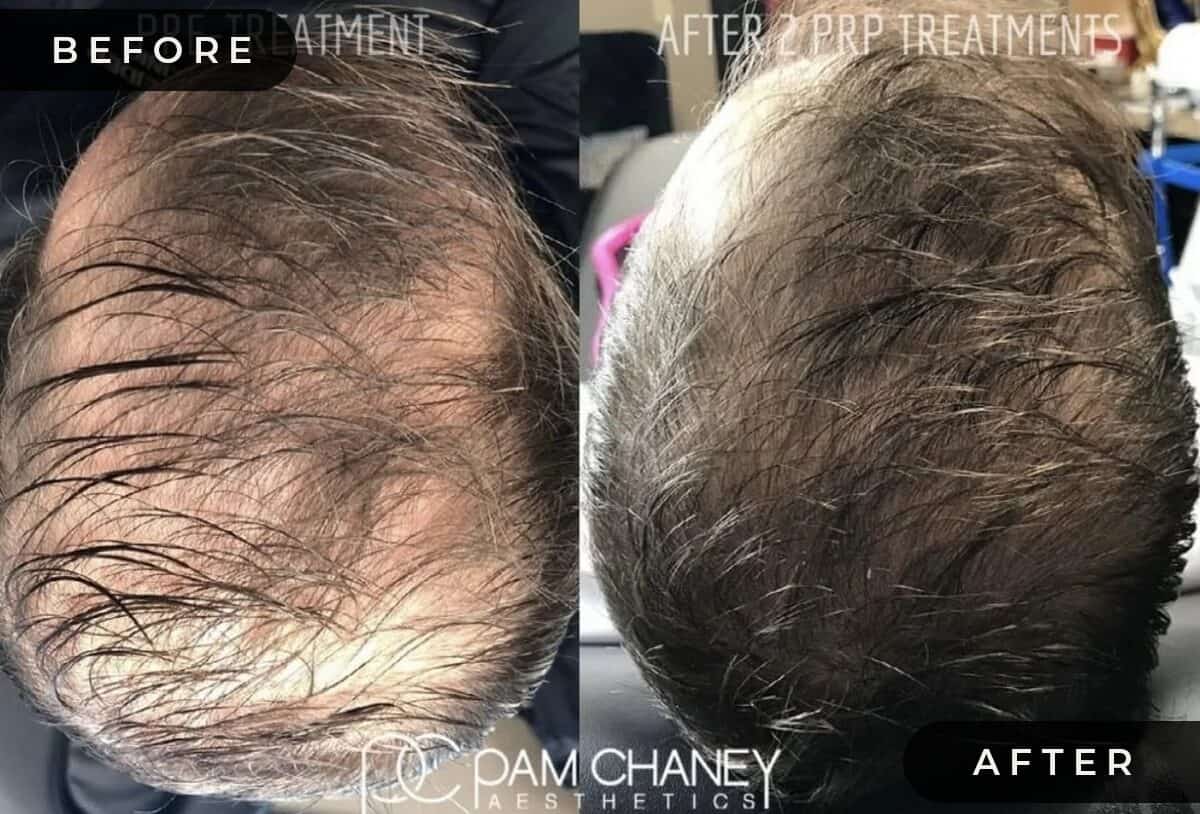 Hair-Restoration | Pam Chaney Aesthetics | Elkhart IN