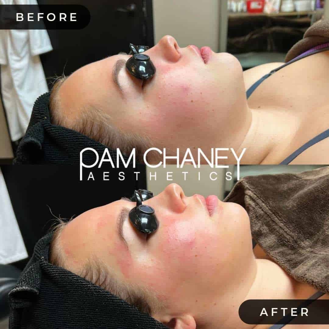 HydraFacial | Pam Chaney Aesthetics | Elkhart IN