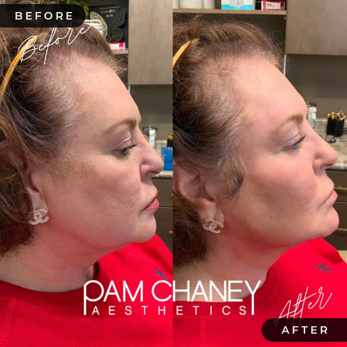 Mini Face Lift | Pam Chaney Aesthetics | Elkhart IN