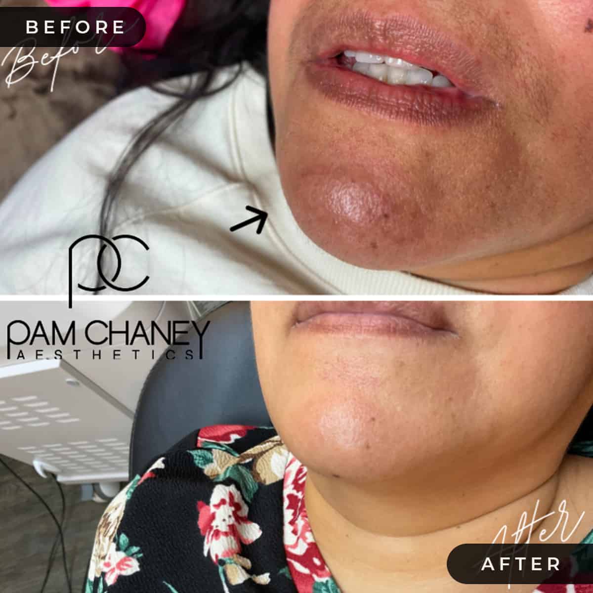 PICO LASER | Pam Chaney Aesthetics | Elkhart IN