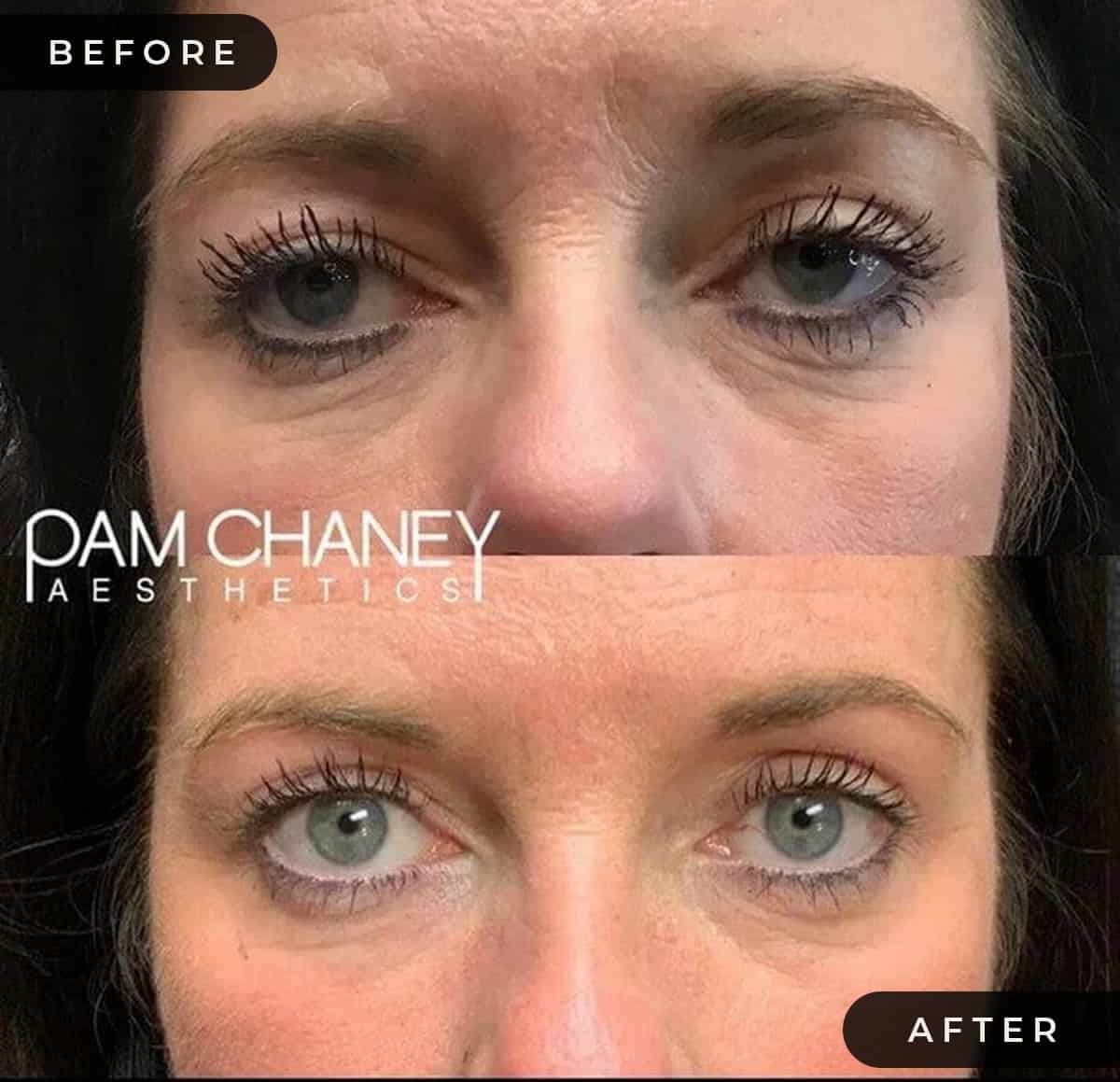 Co2 Pamchaney | Pam Chaney Aesthetics | Elkhart IN