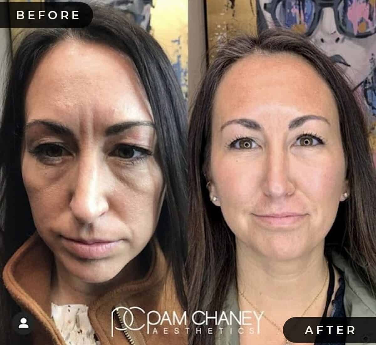 Before And After | Pam Chaney Aesthetics | Elkhart IN