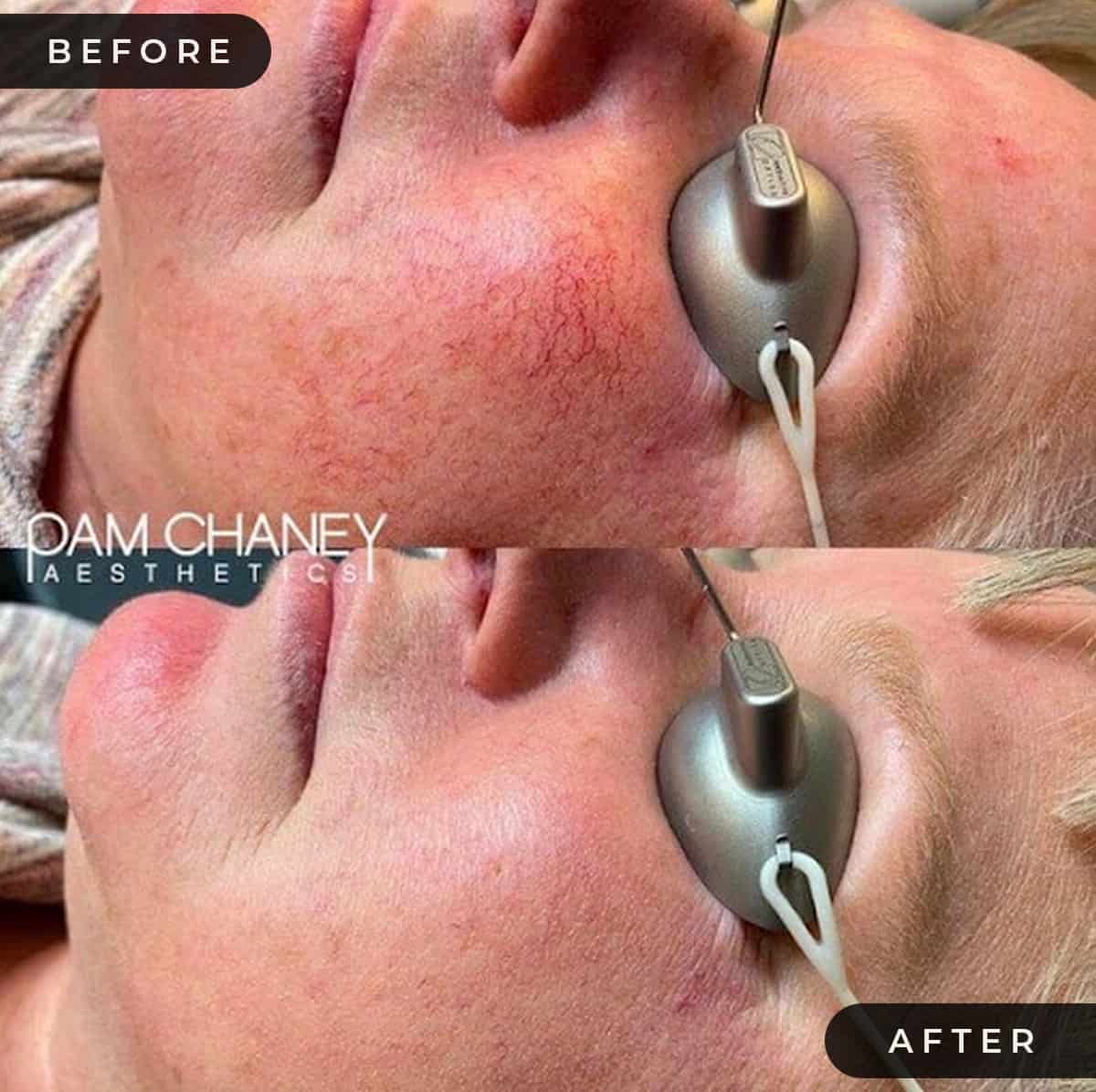 Before And After | Pam Chaney Aesthetics | Elkhart IN